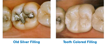 Tooth Fillings